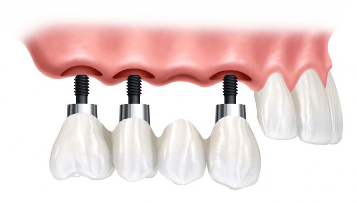 Çoklu Diş Eksikliklerinde Dental İmplant Tedavisi