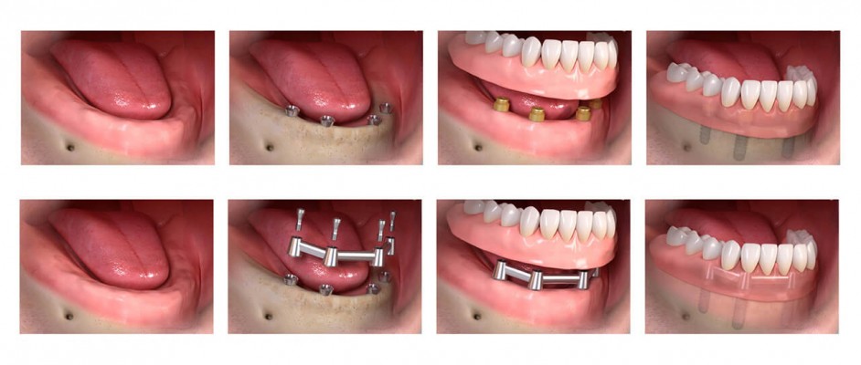 Total Diş Eksikliğinde Dental İmplant Tedavisi