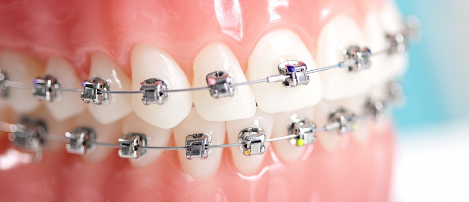 Ortodontik Tedavi Yaşı