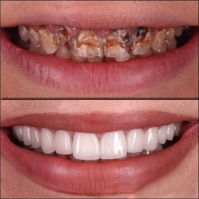 Dental Asit Erozyonu Nedir?