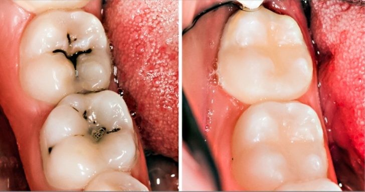Diş Çürüğü Nedir Ve Nasıl Oluşur?